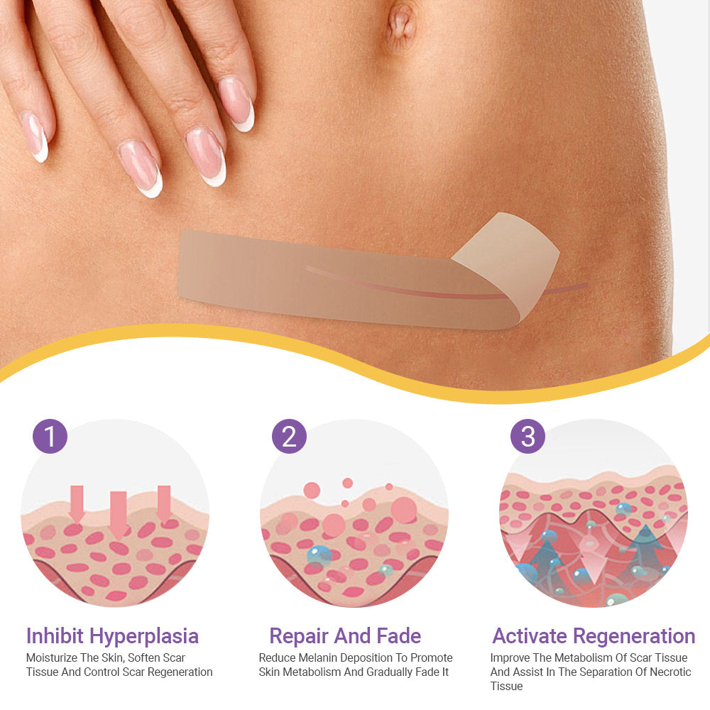 ✅Official Store |Ourlyard® Hyaluronic Acid Nano Microneedle Repair Tape🦘🏥(Treatment of old and new scars, reduction of surgical scars, stretch marks, keloids, acne, burns, warts, dermatomes and varicose veins)