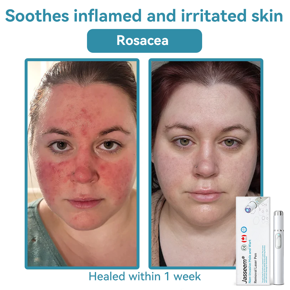 𝐉𝐚𝐬𝐬𝐞𝐞𝐦® Medical-Grade Laser Pen 🔥 (Powered by CO₂ laser technology – effectively removes moles, warts, skin tags, pigmentation spots, and other skin imperfections)🏆